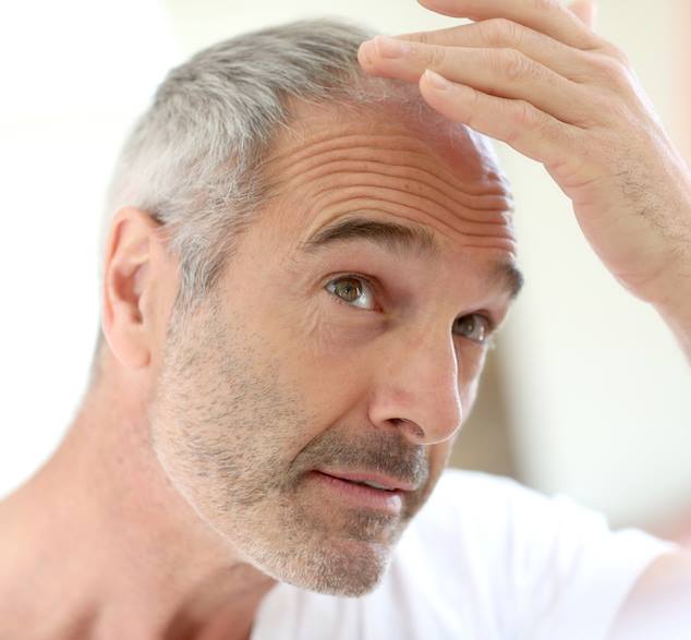 Calvitie, Homme Se Coiffant La Tête Avec Un Peigne. Main Masculine Sur Un  Chauve, Personne Préoccupée Par La Perte De Cheveux Banque D'Images et  Photos Libres De Droits. Image 178462543