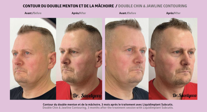Traitement des volumes chez les hommes